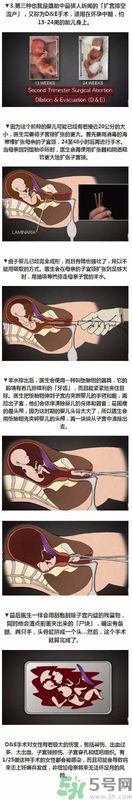堕胎手术的可怕细节 姑娘们你还堕胎吗?多图
