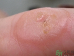 手上长水泡是什么原因?手上长水泡很痒怎么办?