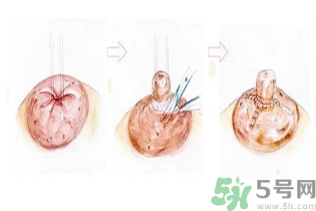 乳头内陷怎么回事？乳头内陷的原因是什么？