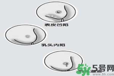 乳头内陷怎么矫正？乳头内陷矫正方法是什么？