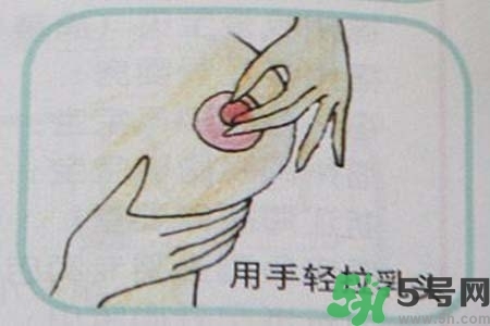 乳头内陷怎么矫正？乳头内陷矫正方法是什么？