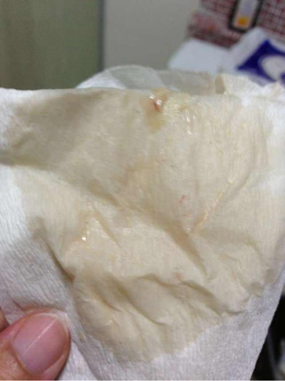 
	孕妇孕晚期见红图片 究竟啥样的
