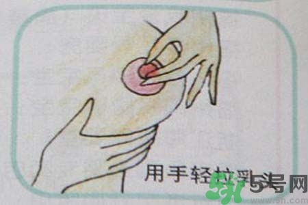 乳头内陷怎么办？乳头内陷的症状有哪些？