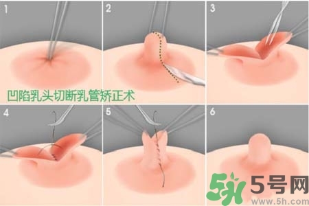 乳头内陷怎么办？乳头内陷的症状有哪些？