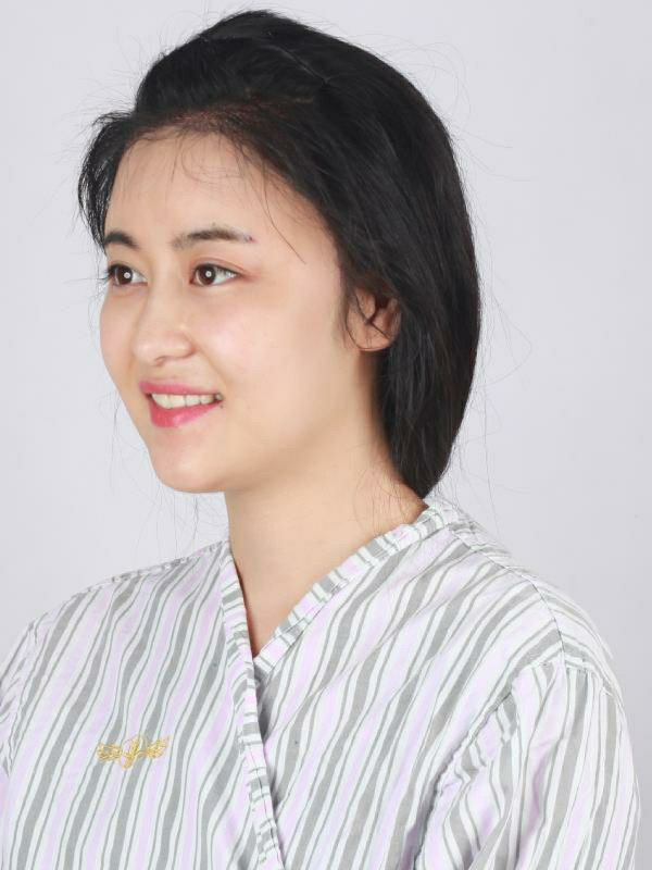 做了长发植发后发际线到底有多长？