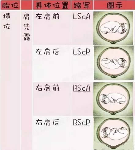 
	胎位图 各种胎位图全解
