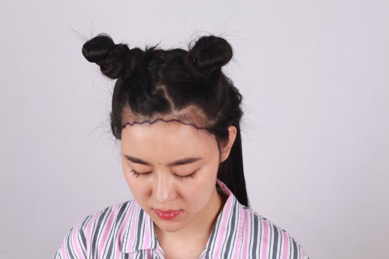 为什么不剃发长发植发长度是8cm？