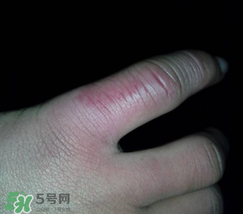 小拇指冻肿了怎么办？为什么小拇指容易冻？