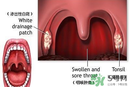 口含大蒜能治疗咽炎吗？巧用大蒜治疗咽炎咳嗽