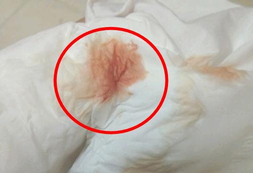 
	刚怀孕着床出血的图片 颜色是褐色还是红色？
