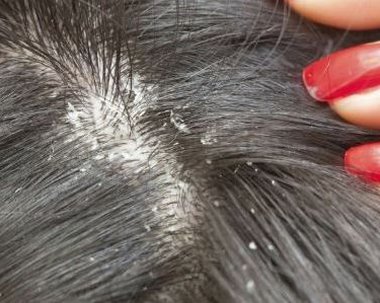 头皮干燥头屑多怎么办 干性头屑和油性头屑的区别