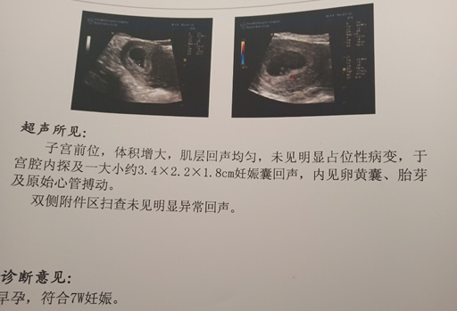
	孕囊大小看男女99%准确对照表真的吗(附公式解析及详细对照表)
