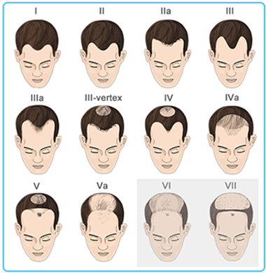 男性脱发是什么原因引起的 男生脱发原因及治疗方法