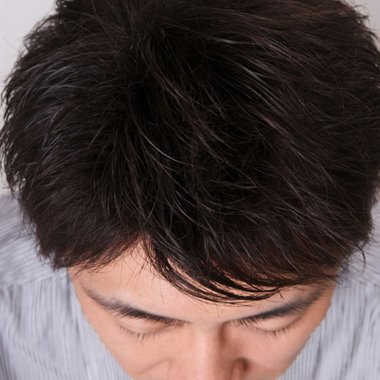 男士头顶贴发片的危害 头顶真发假发片