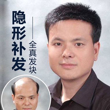 男士头顶贴发片的危害 头顶真发假发片