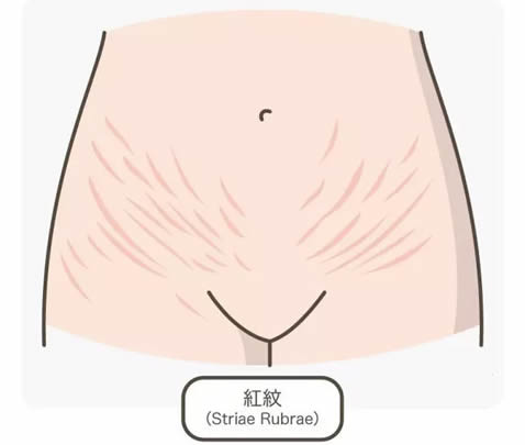 
	开始长妊娠纹的前兆图 妊娠纹刚开始什么样子图
