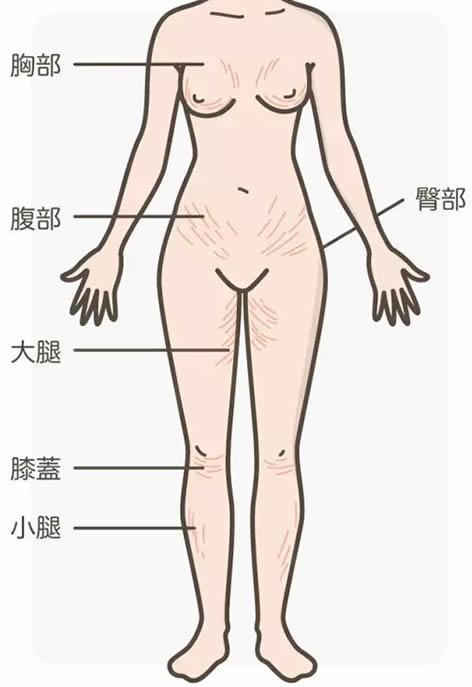 
	开始长妊娠纹的前兆图 妊娠纹刚开始什么样子图
