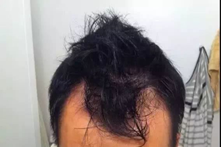深究脱发六大原因，解决秃头问题从根源下手