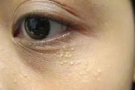 脂肪粒是怎么形成的？这四个原因及时改善变美
