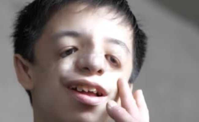 男孩患鸟面综合症 是什么原因导致的？ 