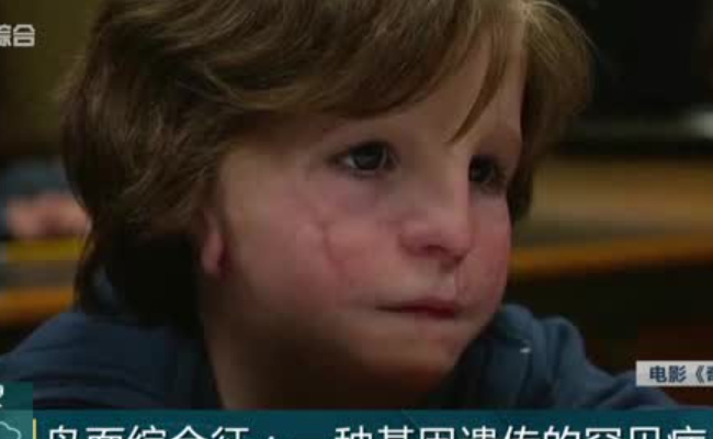 男孩患鸟面综合症 是什么原因导致的？ 