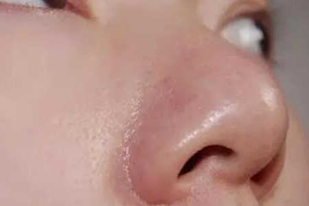 脸上出油太多怎么解决？这四个方法教你控油清爽一整天