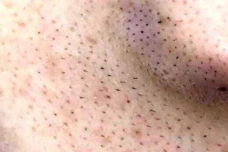 如何把脸上的黑头去掉？这三个去黑头最有效的方法