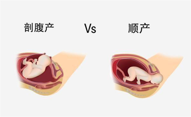 顺产比起剖腹产有3大好处 过来宝妈建议 能顺产就顺产 