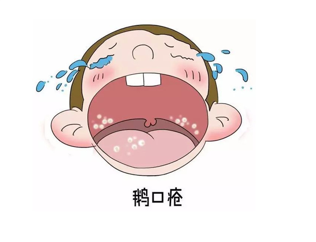 什么是新生儿鹅口疮 