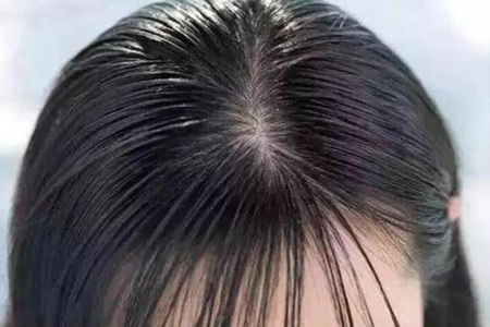 头发油怎么办？这三个头发油解决小妙招