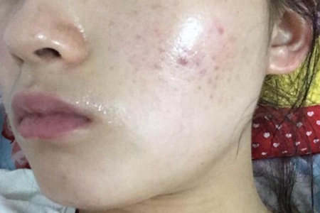 脸上长痘痘如何消除？这五个脸上长痘痘消除小妙招