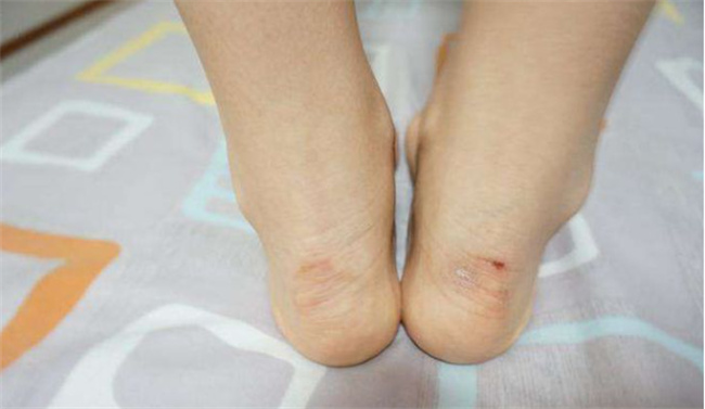 鞋子磨脚怎么办 新鞋磨脚会一直磨脚吗 