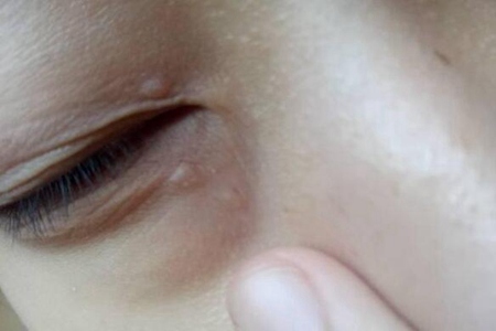 脂肪粒怎么消除在眼睛旁边的？这四个眼部脂肪粒去除方法
