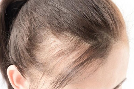 女性脱发是什么原因造成的？这四个诱因引发及时改善
