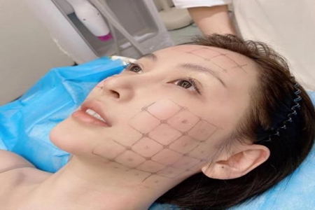 做热玛吉有什么误区？了解热玛吉知识正确美容
