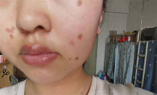 点痣前点痣后注意事项有哪些呢 