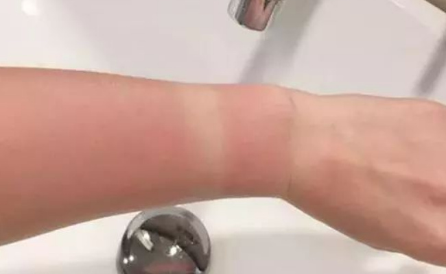 怎么去除晒印，要如何有效防晒呢 
