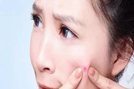 痘痘破了能用手挤吗？痘痘破了怎么卫生处理