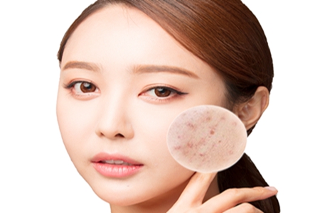 为什么会产生粉刺？脸上长粉刺是什么原因？