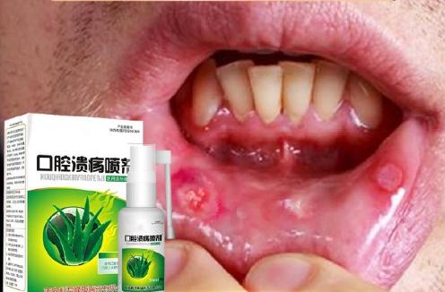 分享嘴巴上火起泡溃烂怎么快速消除小妙招 